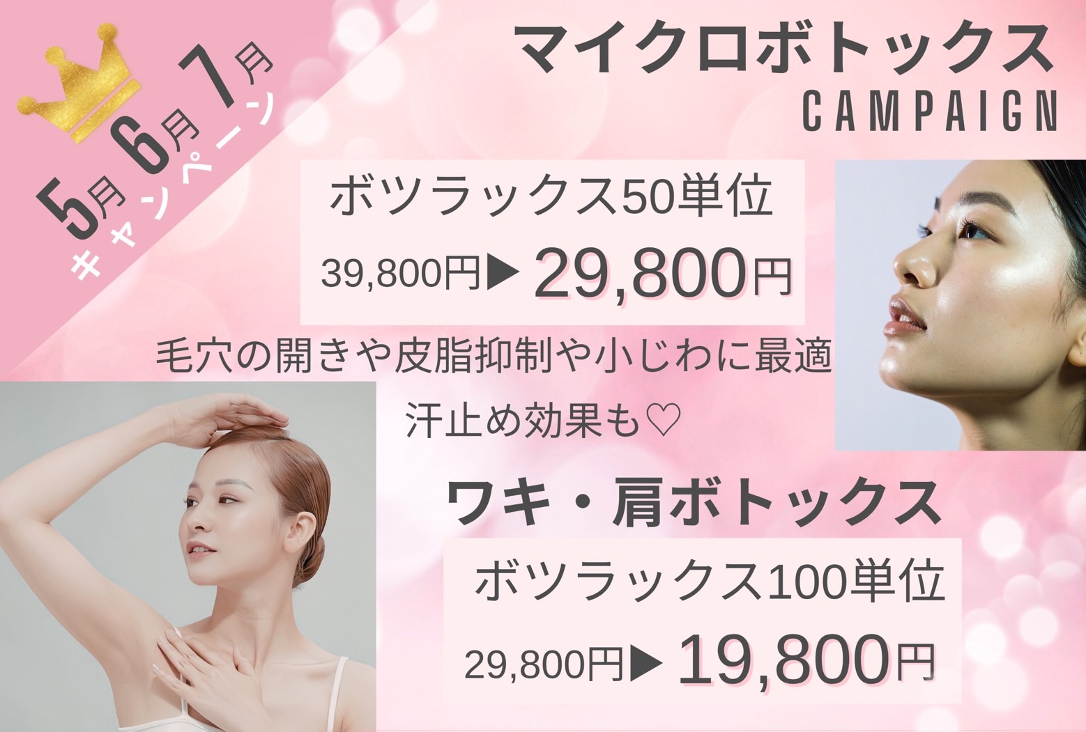 ボトックスキャンペーン